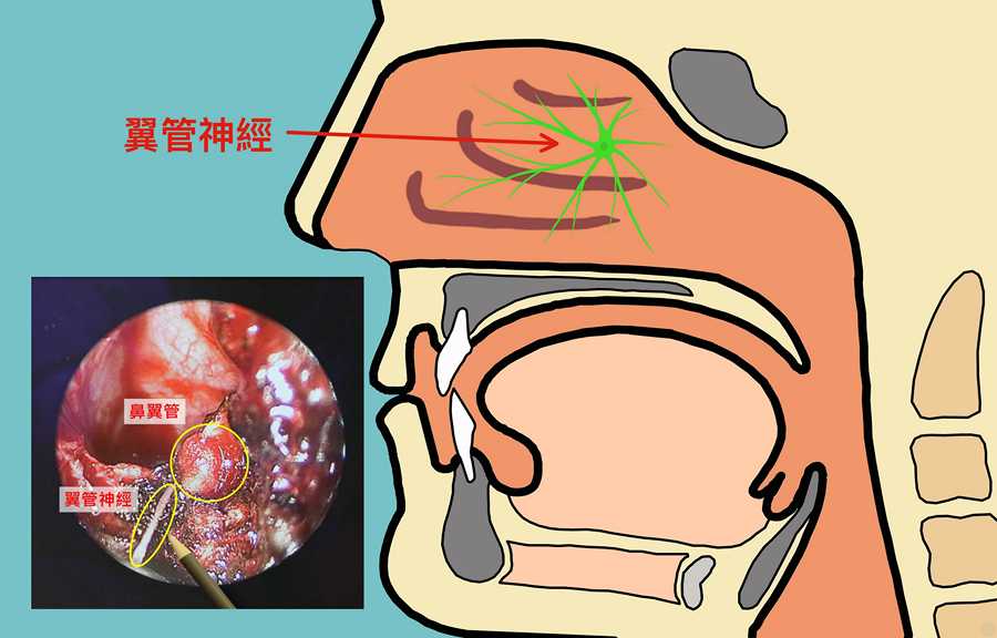 翼管神經位置示意圖。(製圖:江柏緯、馬順德)