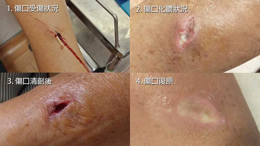 吳女士兩次住院接受抗生素治療的傷口變化狀況。(王瑞興醫師提供)