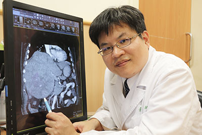 貪杯逾40年 喝出23公分霸王級肝癌腫瘤