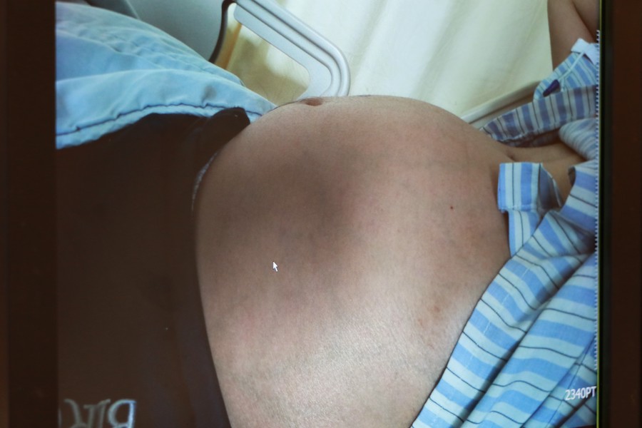 男子腹部隆起如懷胎 切除4公斤巨癌撿命