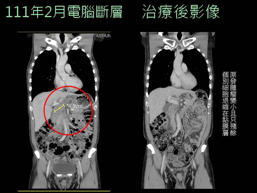 化療加免疫療法胃癌四期變一期 病人慶重生