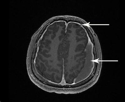 「自發性顱內低壓」合併「硬腦膜下出血」治療的臨床研究結果