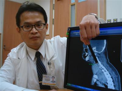 罕見絲瓜大甲狀腺結節 逾13公分腫塊壓迫氣管